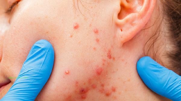 Can fish oil DHA cause allergies