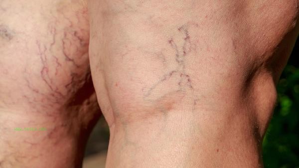 Is leg cramps due to zinc deficiency or calcium deficiency