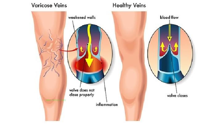 How to treat knee pain in winter? The first choice for medication treatment for knee pain in winter is fast
