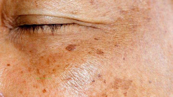 What to do about spring health and skin allergies? The two best elements to know about skin allergies