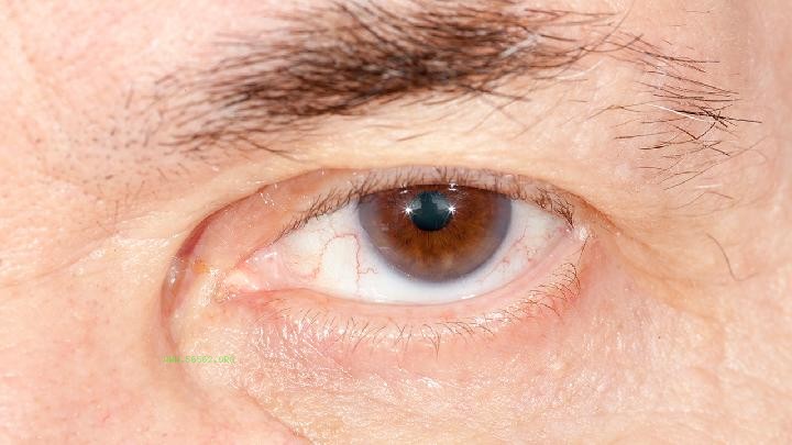 Explanation: Removing eye bags does not necessarily require surgery!