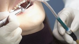 How long does it take for the gap between teeth to recover after teeth cleaning?