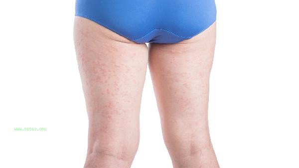 What causes pain in the inner thigh muscles