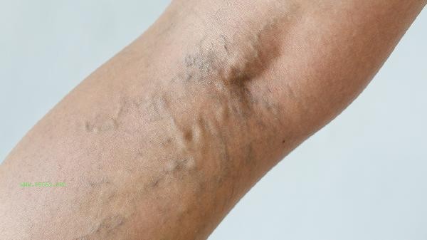 What causes muscle weakness in the arms