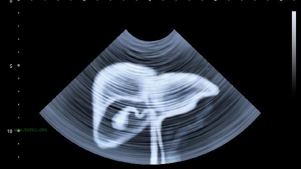 What causes abdominal muscle strain