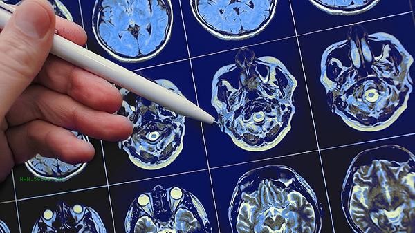 How long can cerebral hemorrhage blood clots be completely absorbed