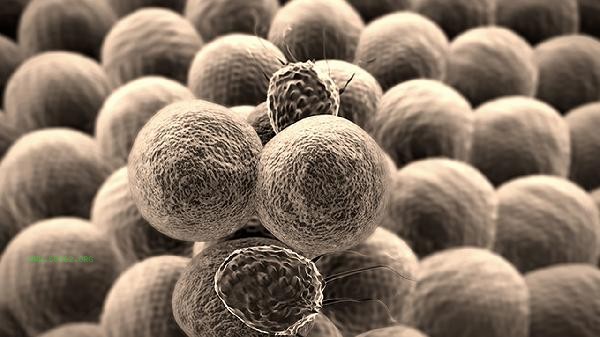 How many cases of high eosinophils are considered severe