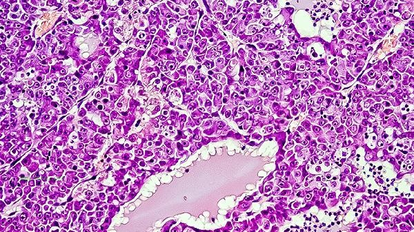 What does a high eosinophil count indicate