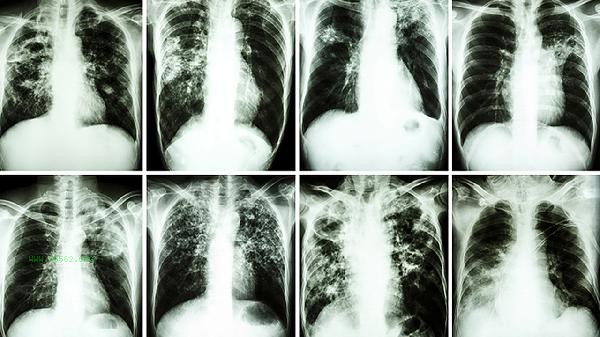 Can aldehyde ketone reductase 3600 cause cancer