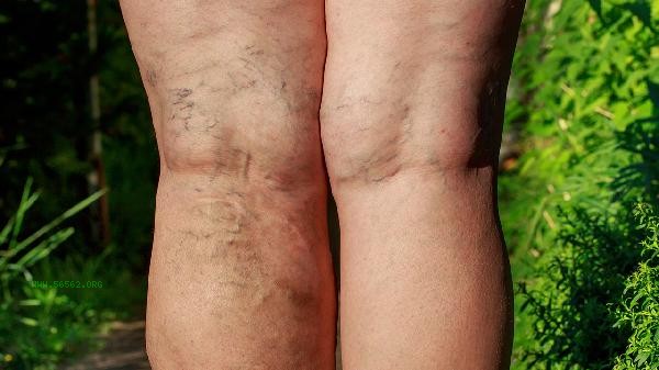 What are the common diseases associated with superior vena cava compression