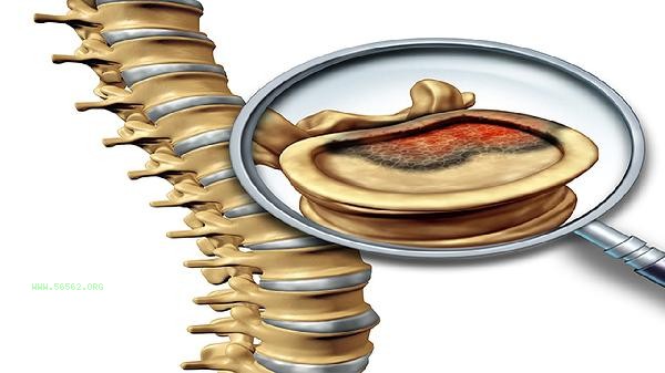 Which is more severe, intervertebral disc protrusion or bulging
