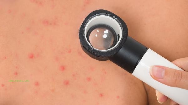 What traditional Chinese medicine can treat flat warts and remove roots
