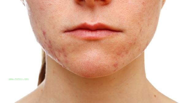 Do people who love acne have illnesses