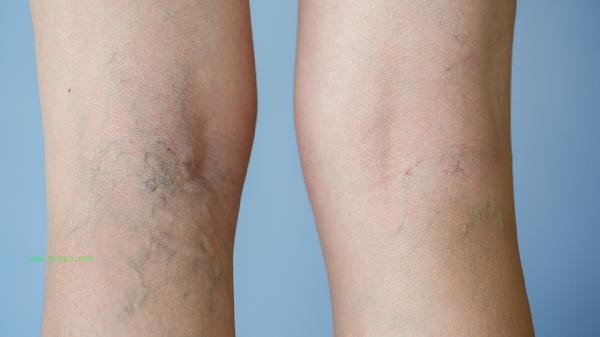 Can muscle contraction syndrome be cured? How much does it cost