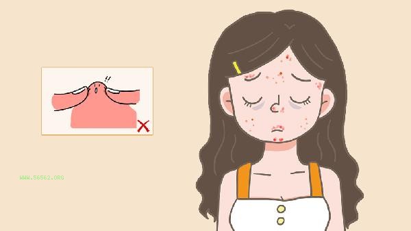 How can people who love acne improve