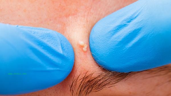 Is acne patch effective for closing the mouth