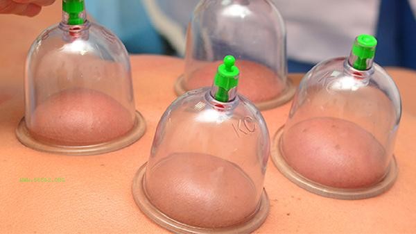 Is Shanghe cupping effective for weight loss