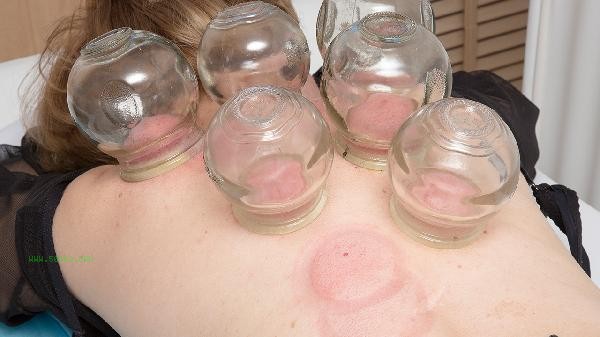 Cupping for weight loss usually encounters a bottleneck period when it comes to how many pounds to lose