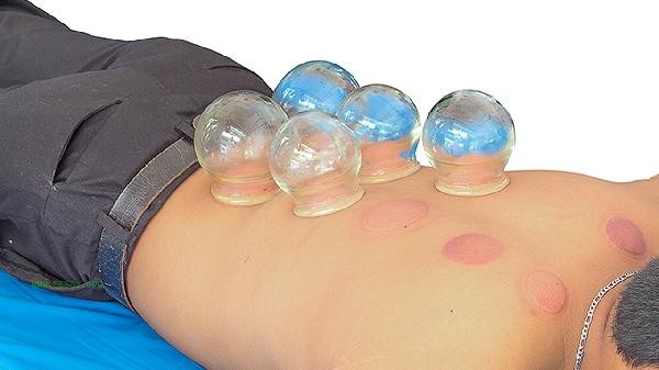 When to remove cupping for weight loss
