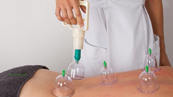 What's going on with cupping to lose weight and lose more weight