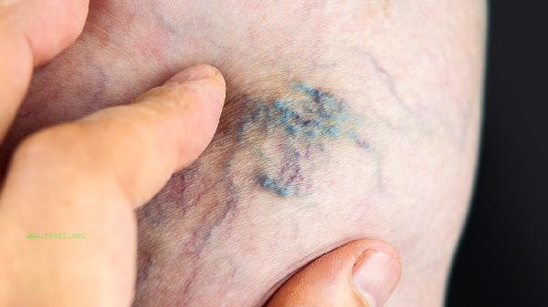 Do you regret the thigh liposuction