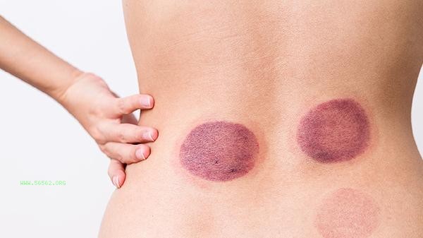 What's wrong with slow weight loss due to cupping