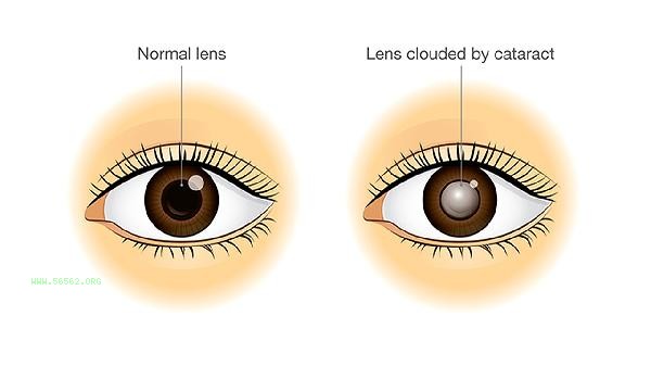 How much does eyelid liposuction cost approximately