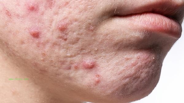 How to reduce the flesh at the junction of the chin and neck