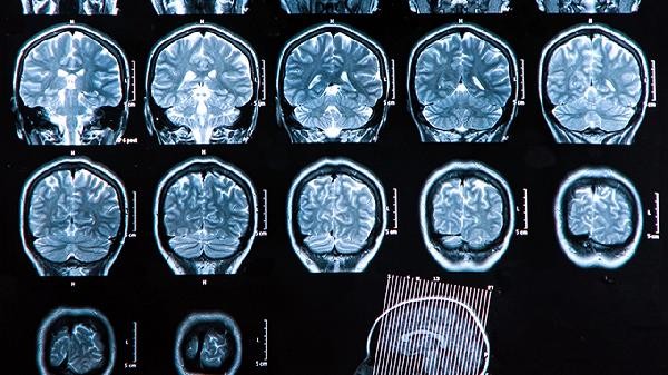 Is it normal for the brain to always be in a distracted state
