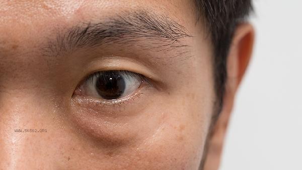 Will pulling out eyebrows and eyelids cause sagging