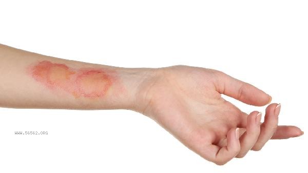 Emotional Trauma Stress Syndrome