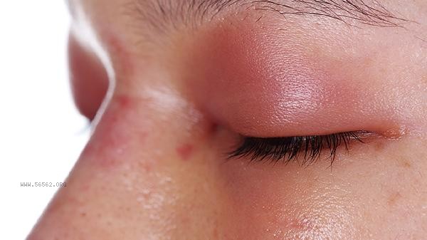 How long can the V-face lifting needle last? The harm of V-face lifting needle