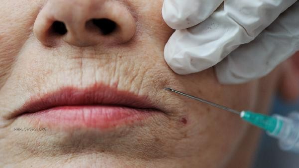 Is there any side effect of lifting V-face? How long can V-face be maintained