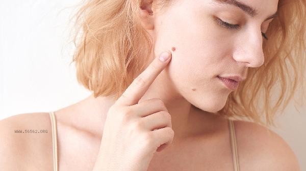 Is it necessary to remove irregular melanocytic nevi
