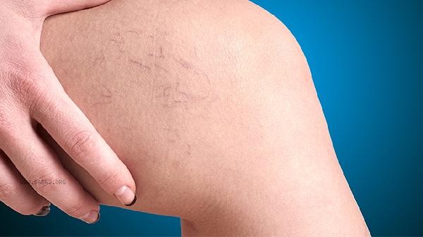 Is 1.1cm of hepatic portal vein normal