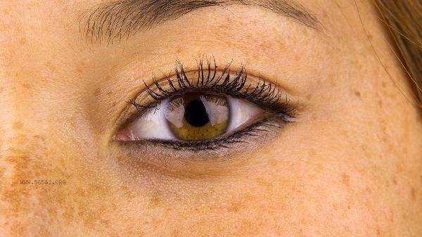 How does melasma on a woman's face form