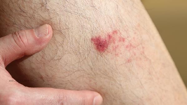 Can low platelet count lead to skin bruising?