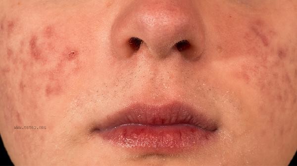 What is the reason for yellow spots