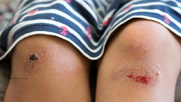 Is the ointment for treating burn scars effective