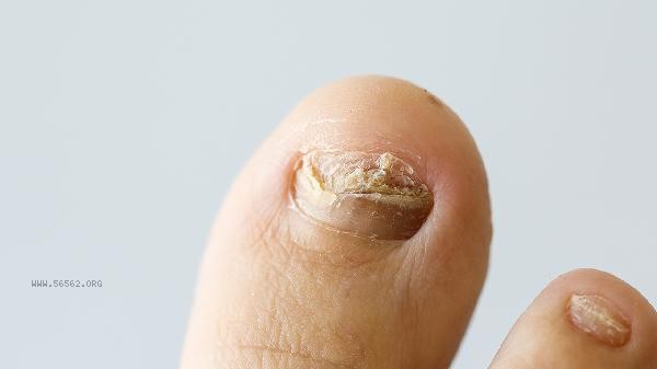 How to check for onychomycosis