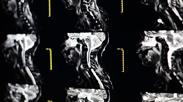 Is the head and neck CTA examination significant